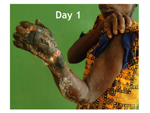 Buruli ulcer Ivory Coast flesh-eating disease cure, necrotizing fasciitis, staph, healing, amputation alternative. Africa