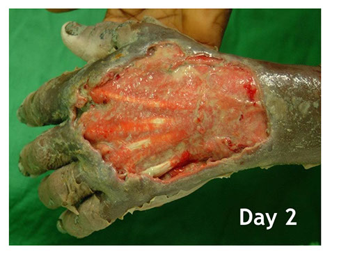 Buruli ulcer Ivory Coast flesh-eating disease cure, necrotizing fasciitis, staph, healing, amputation alternative, Africa