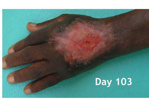 Buruli ulcer Ivory Coast flesh-eating disease cure, necrotizing fasciitis, staph, healing, amputation alternative, Africa